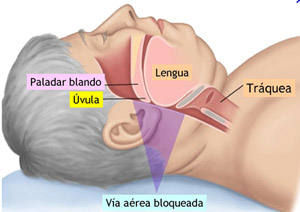 apnea