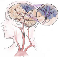 ictus